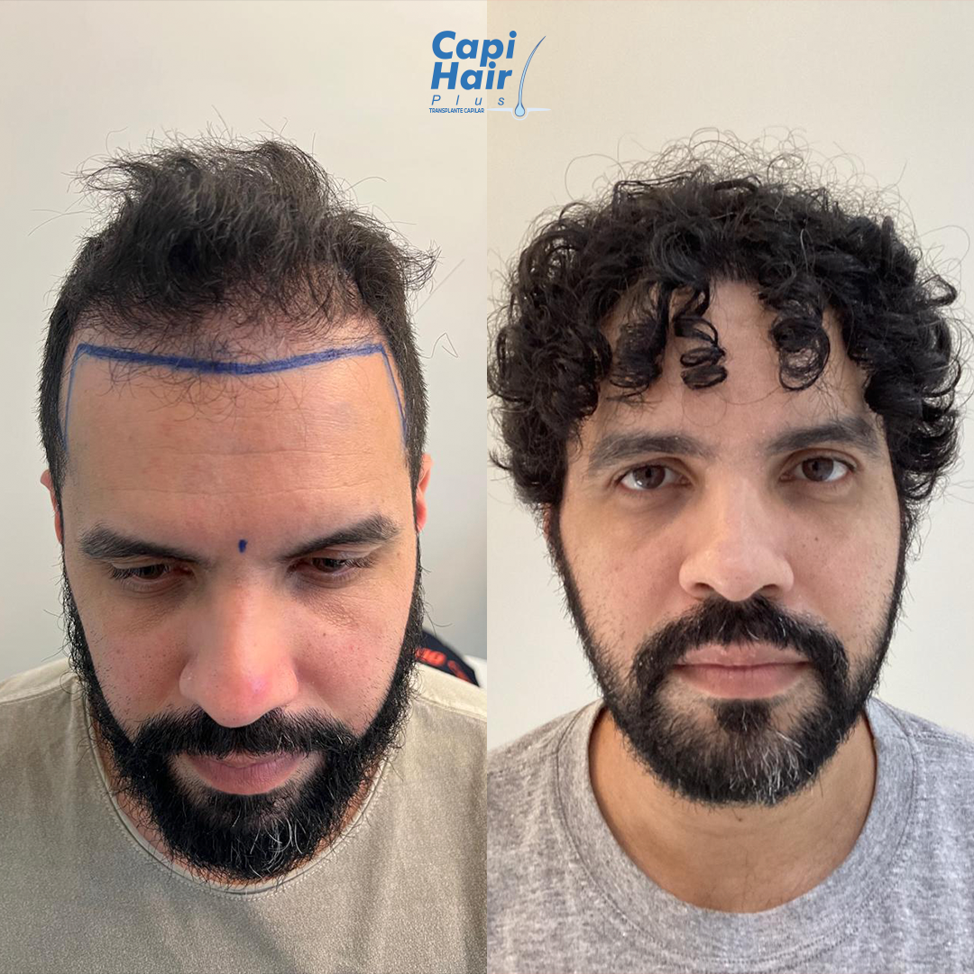 Antes e depois 1