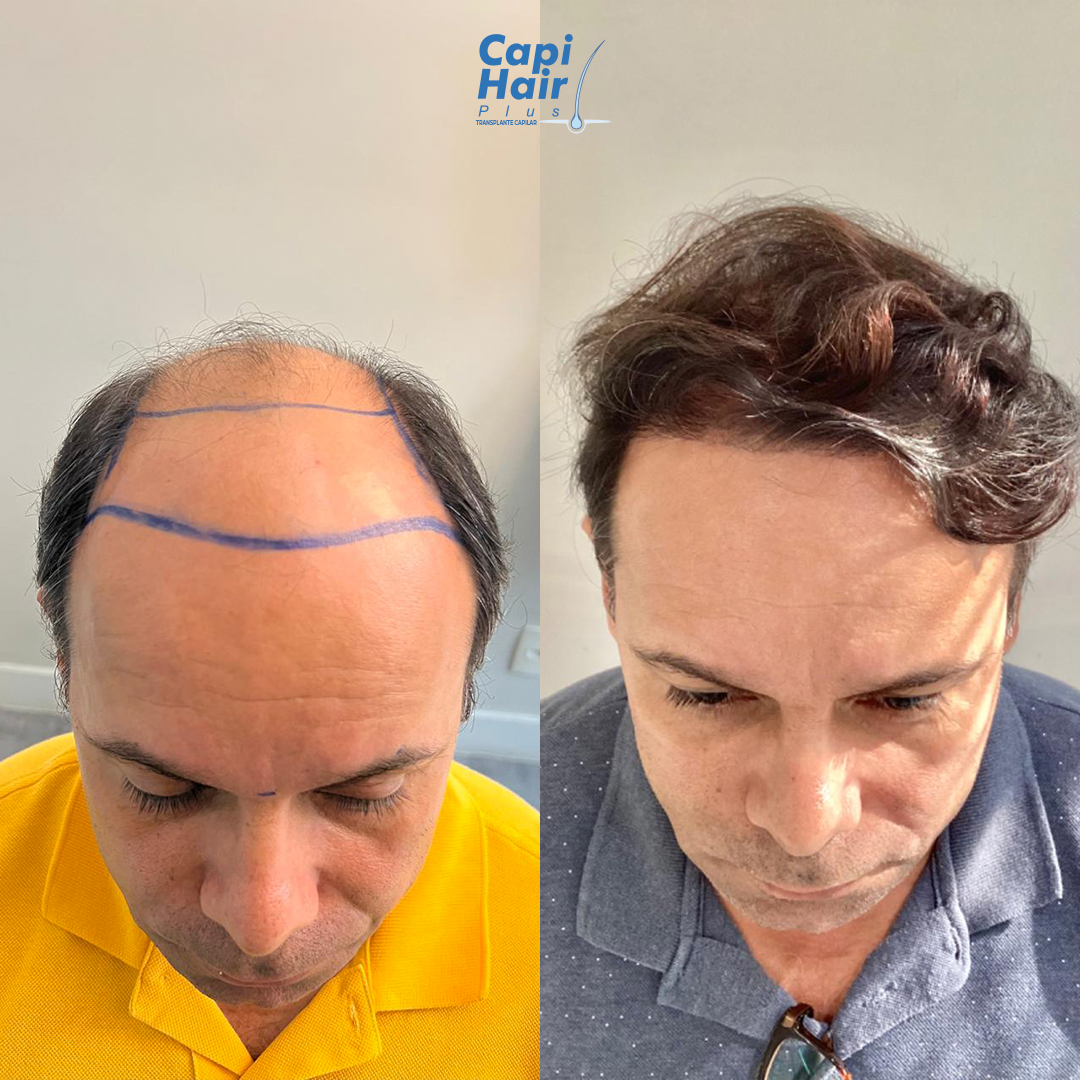 Antes e depois 2