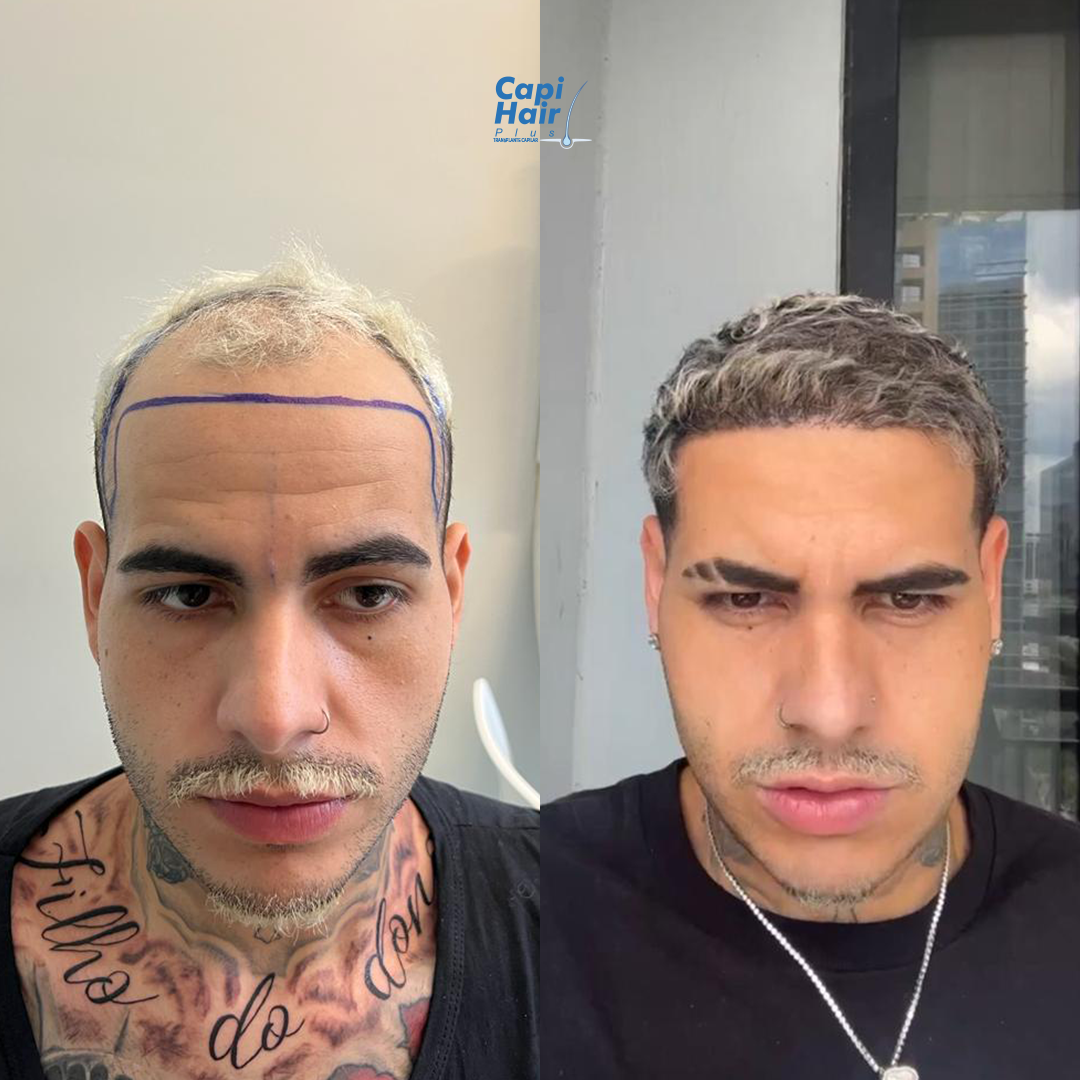 Antes e depois 3