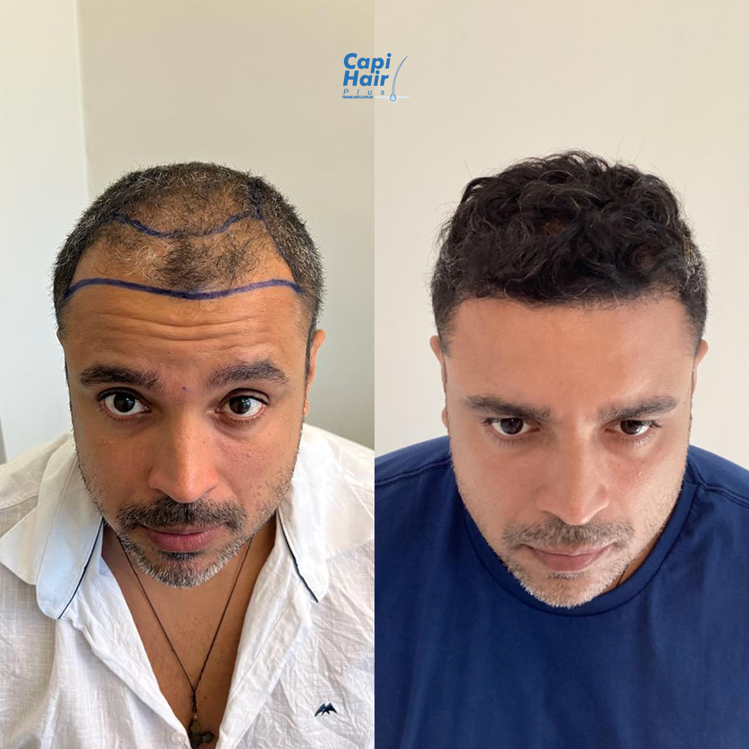 Antes e depois 4