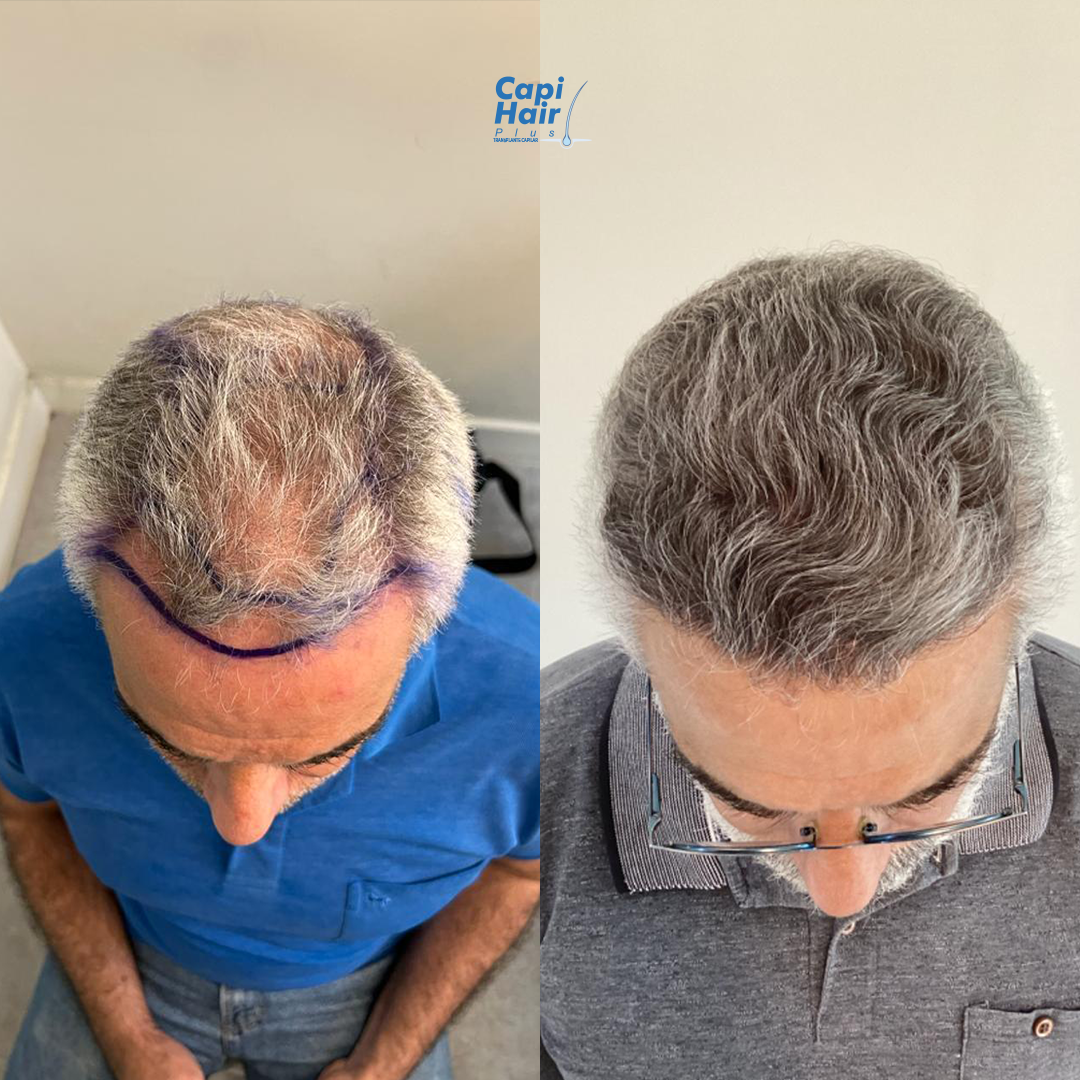 Antes e depois 5