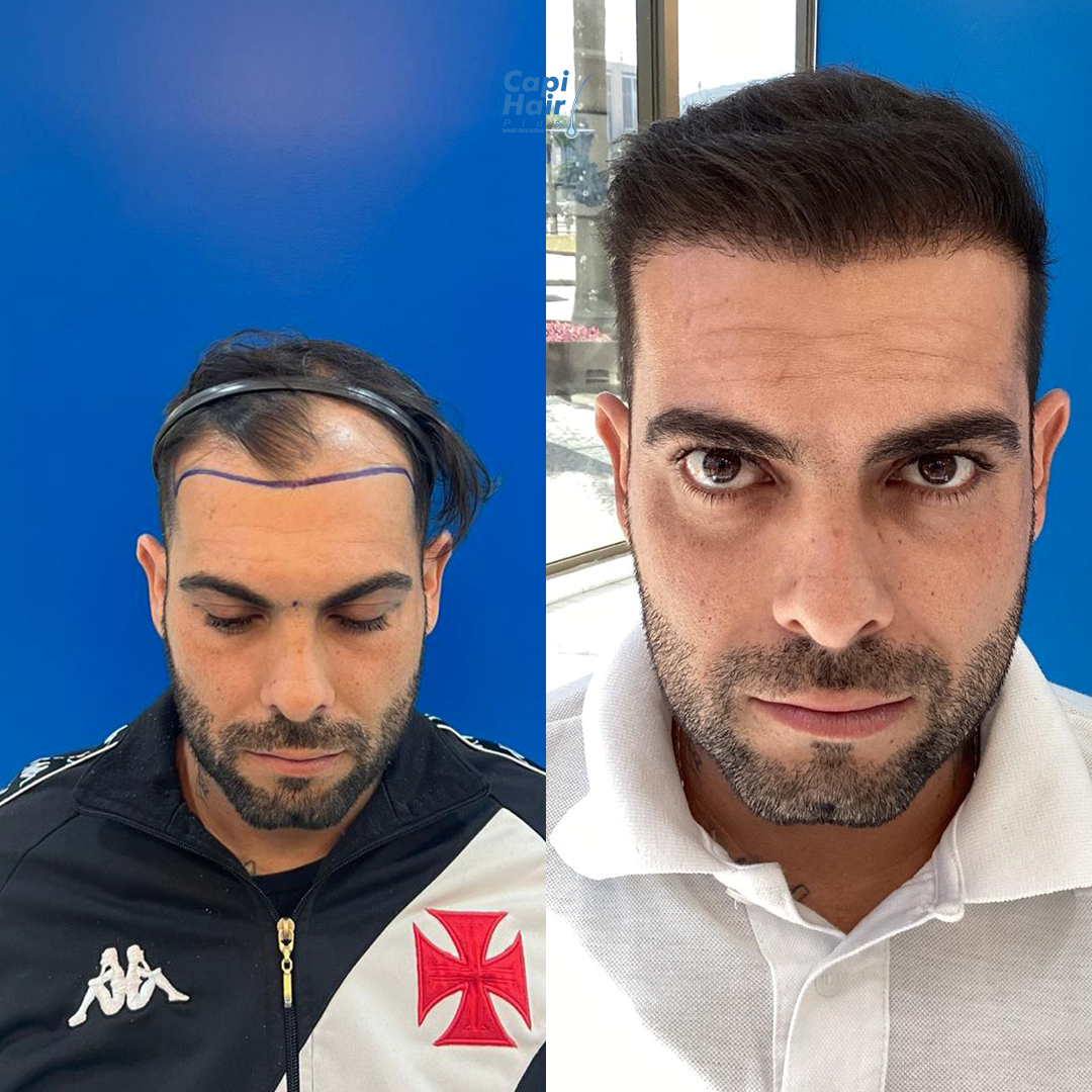 Antes e depois 6